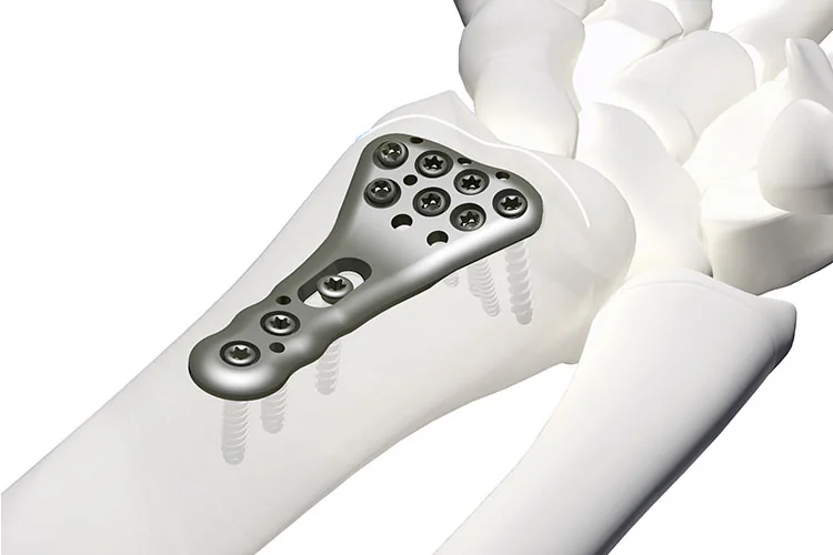 Orthopedic Plates — Product 0001 — Orthopedic Plates
