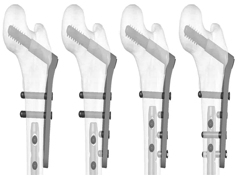 Orthopedic Plates — Product 0013 — Orthopedic Plates