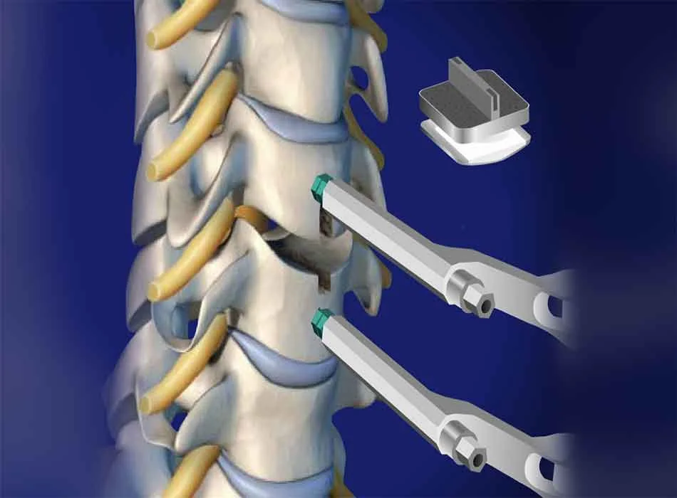 Cervical Instruments — Product 0115 — Cervical Instruments