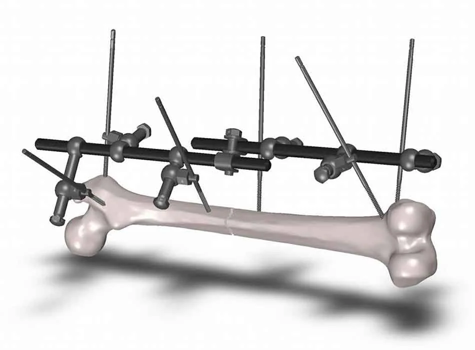 Orthopedic Instruments — Product 0309 — Orthopedic Instruments