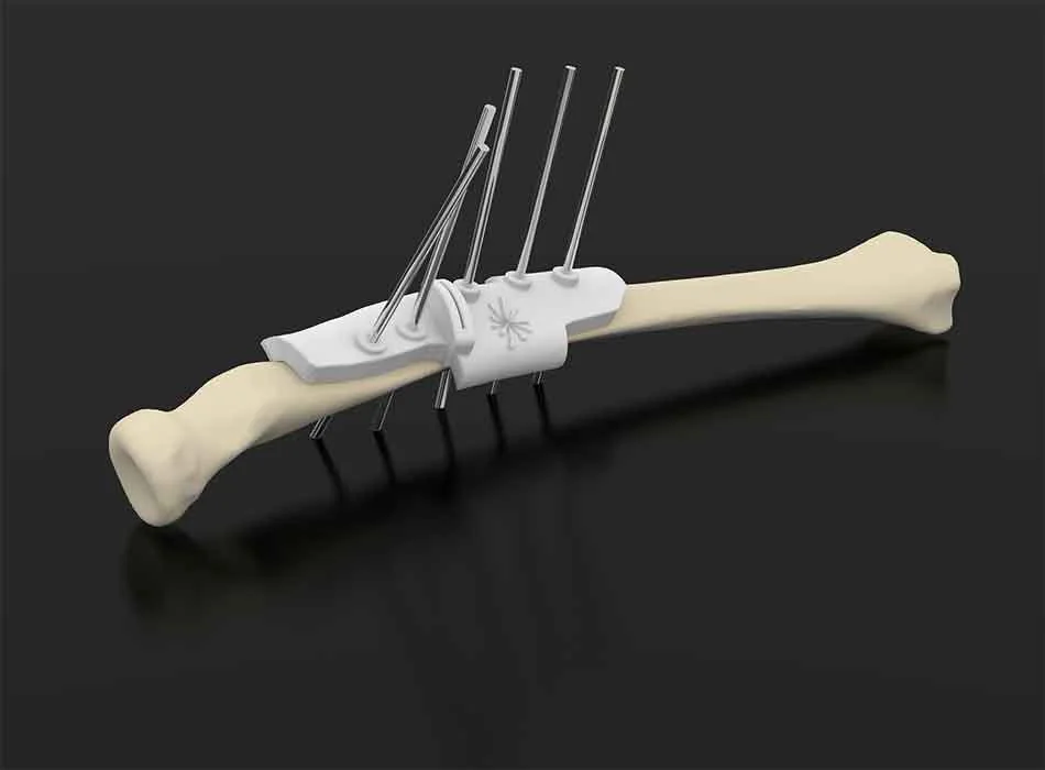 Orthopedic Instruments — Product 0313 — Orthopedic Instruments