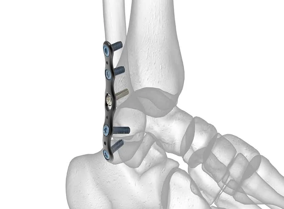 Orthopedic Instruments — Product 0326 — Orthopedic Instruments