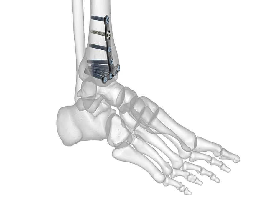 Orthopedic Instruments — Product 0327 — Orthopedic Instruments