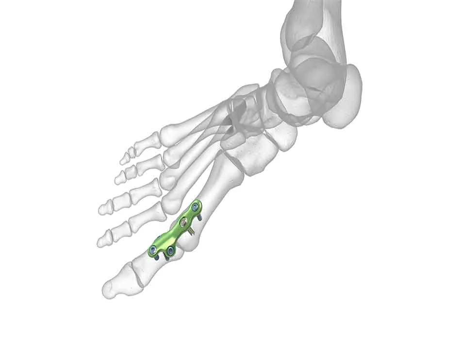 Orthopedic Instruments — Product 0328 — Orthopedic Instruments