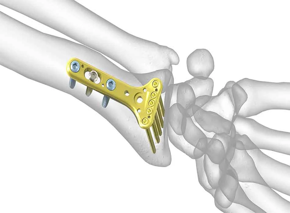 Orthopedic Instruments — Product 0329 — Orthopedic Instruments