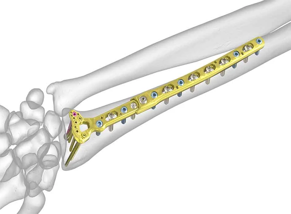 Orthopedic Instruments — Product 0330 — Orthopedic Instruments