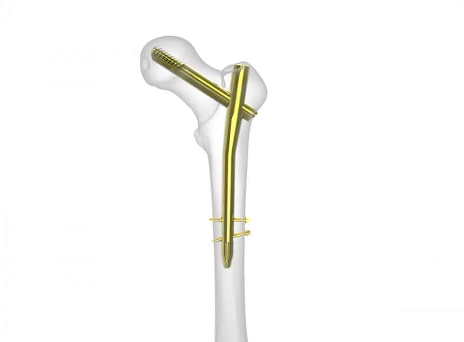 Orthopedic Instruments — Product 0332 — Orthopedic Instruments