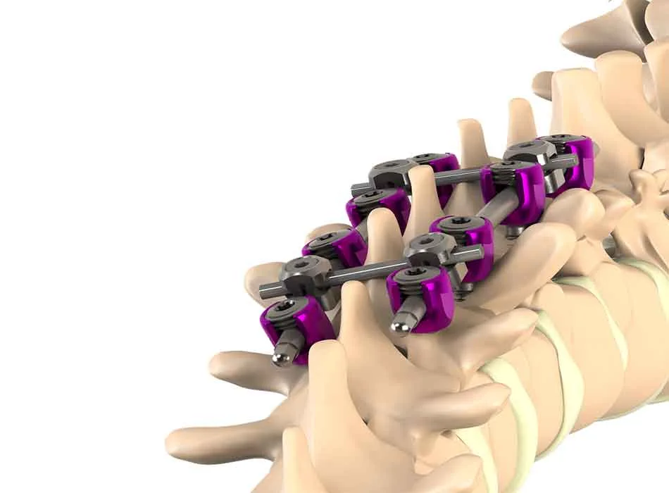 Spinal Instruments — Product 0336 — Spinal Instruments