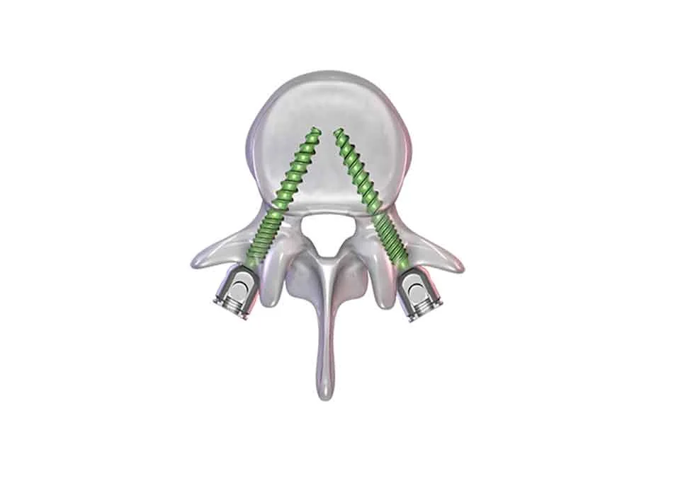 Spinal Instruments — Product 0338 — Spinal Instruments