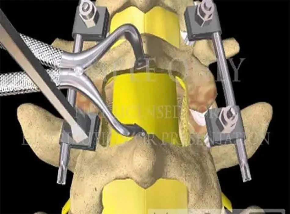 Cervical Instruments — Product 0359 — Cervical Instruments