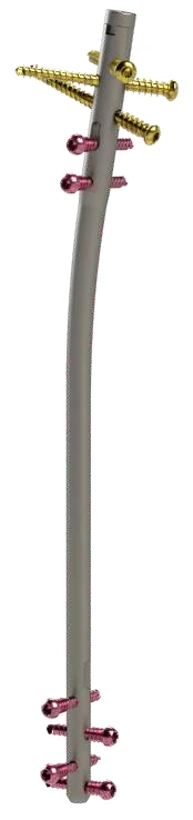 ZTN Tibial Nail Systems