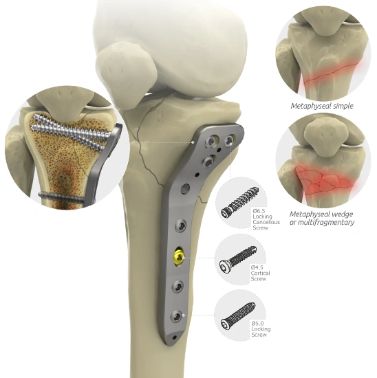 Locking Proximal Medial Tibial Plate