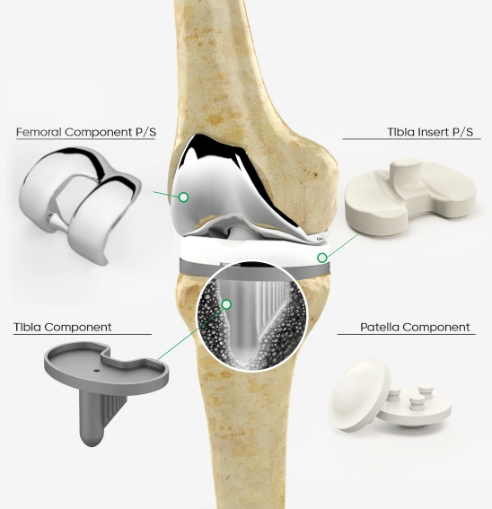 Total Knee Prosthesis P/S